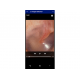 Vidéo de l'intérieur d'une oreille vue avec l'otoscope Macroview